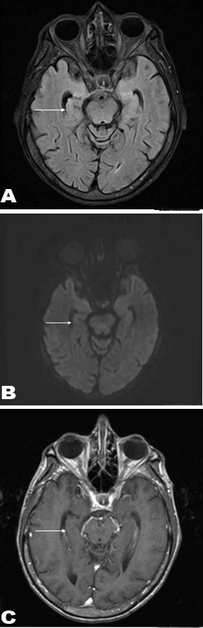 In difficult cases, history of primary malignancy, serum and cerebrospinal fluid analysis help in making the correct diagnosis. Idiopathic limbic encephalitis can have similar MRI findings as PLE.
