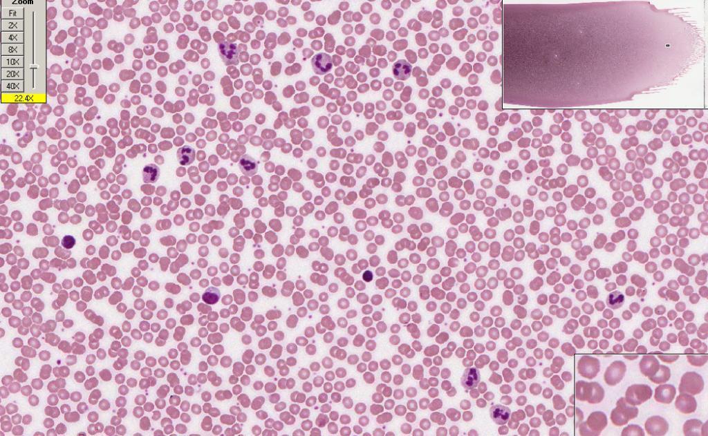 Neutrophils platelets Neutrophils Large lymphocyte