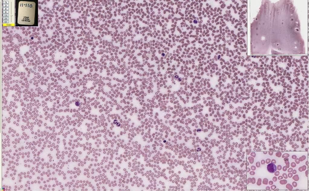 110 110 Peripheral blood smear (Leishman-Giemsa) Monocyte