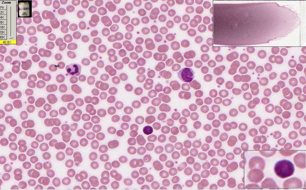 Slide 113 Peripheral blood smear