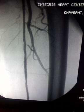 peripheral arteries 3.0mm in diameter.