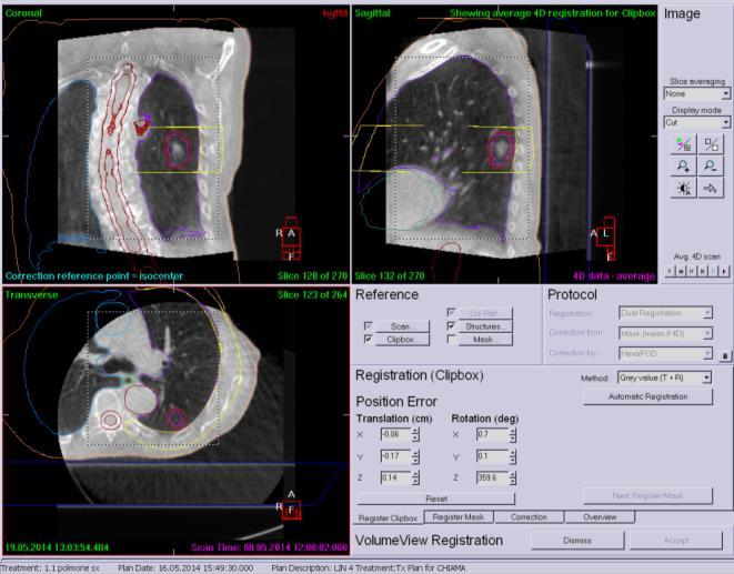 4D-CBCT: correction protocol First, the bony anatomy was rigidly registered using a user-defined 3D rectangular-shaped ROI. We correct set-up of the patient.