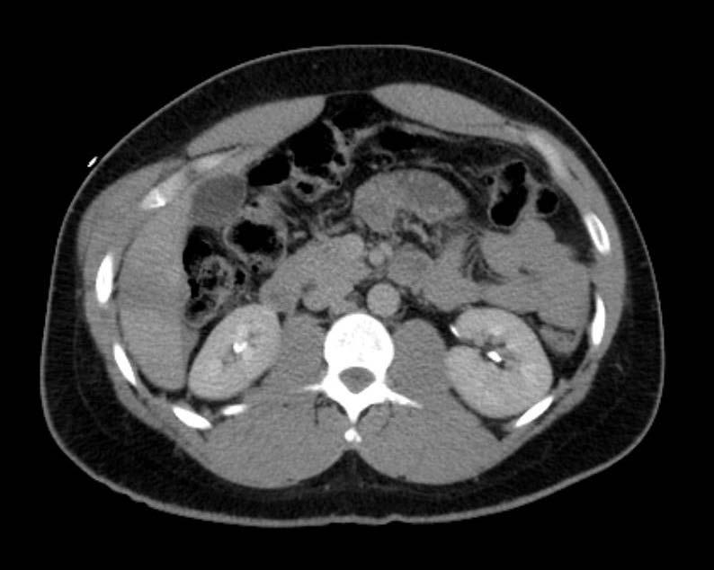 CT abdomen/pelvis GSW at the right lateral thoracic wall tracking through the abdomen with exit wound in the back. Liver hematoma with perihepatic fluid. Perisplenic hematoma.