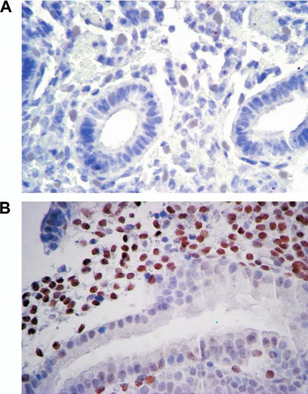 FIGURE 2 Immunolocalization of endometrial HOXA10 from infertile women with hydrosalpinges before (A) and after (B) salpingectomy.