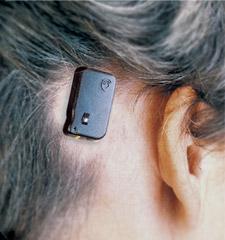 BAHA TM Bone Anchored Hearing Aid: The BAHA is another surgically implanted device available through Cochlear Americas that is most often utilized in cases of severe conductive hearing loss related