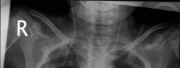 Figure 2: Chest radiograph shows the catheter in the right side of the heart as well detachment