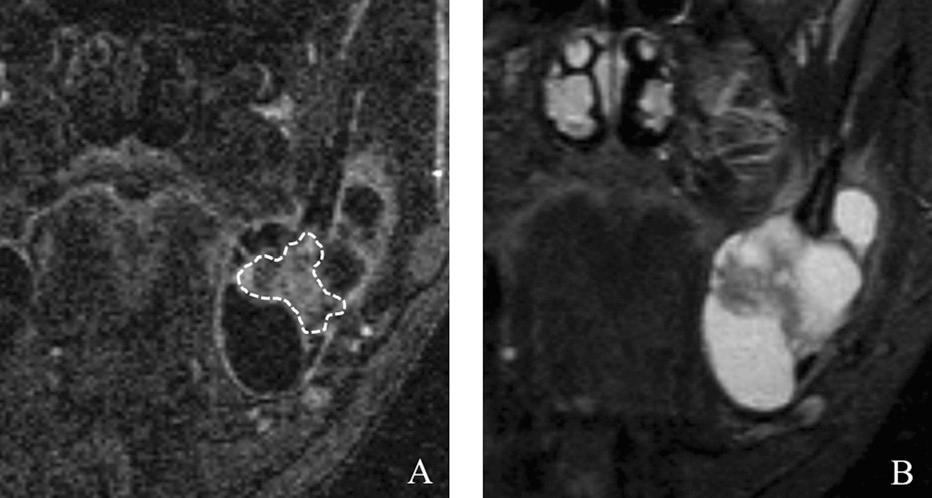 4of9 MRI for odontogenic tumours Figure 2 Ameloblastoma extending from the left mandible to the ramus in a 42-year-old male.
