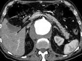 Post-Dissection aneurysm FEVAR in
