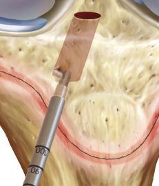 Pass a TigerStick into the joint and retrieve both the tibial TigerStick and the femoral FiberStick out the medial portal together with an