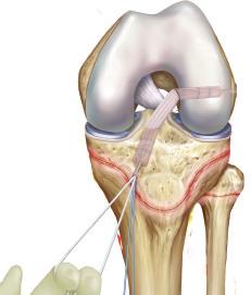 Note: The graft can be fully seated into the femur or