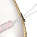both the TightRope ABS loop and the whipstitch sutures