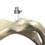 Note two etched lines Figure 6a Figure 5a Figure 4 Figure 5 Figure 6 Figure 7 Signature Primary Acetabular Guide Positioning and Pin Placement (cont.
