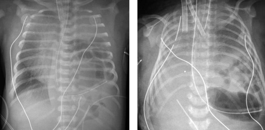 ECMO in infants with CDH 41 Figure 1 (Left) Radiograph findings seen in a typical left diaphragmatic hernia patient. Note that the nasogastric tube is in the left chest.