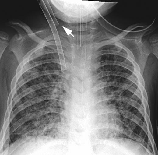 3 Chest radiograph of 29-month-old female illustrates incorrect placement of arterial cannula (arrow), which is too high and resulted in inadvertent displacement of cannula with subsequent