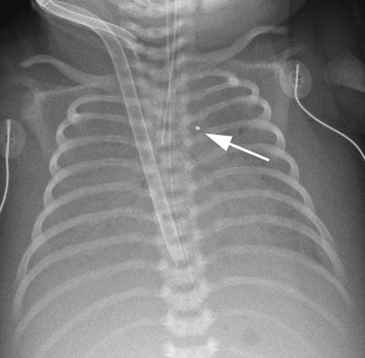 2 Chest radiograph of 23-month-old male shows optimal positioning of two venous cannulae and also shows expected lung white out present during extracorporeal membrane oxygenation. Fig.