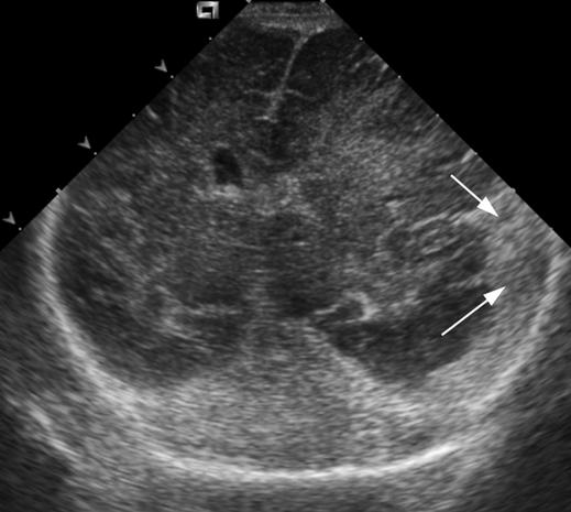 Dense opacification of the lung parenchyma hinders the assessment of the position of support apparatus, with loss of normal mediastinal