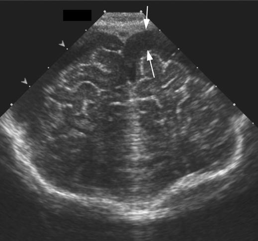 Barnacle et al. Fig. 8 Coronal cranial sonographic image of 6-week-old female illustrates typical widening of CSF spaces around both frontal lobes (arrows).