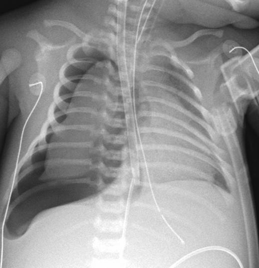 Extracorporeal Membrane Oxygenation in Pediatric Respiratory Failure Fig. 11 Chest radiographs of two infants with pneumothorax. A, 5-week-old male.