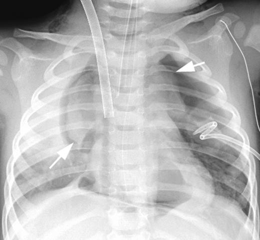 Image shows mediastinal free air and left-sided pneumothorax, with thymus gland (arrows) outlined by mediastinal air.