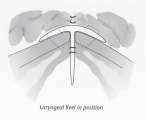 It is designed so that, with a figure-of-eight suture, the keel can be held tightly enough to inhibit synchronous motion between the intralaryngeal keel insert and the vocal cords, thus preventing