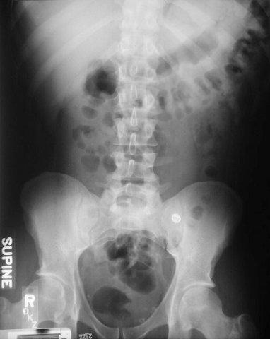 Radiological Evaluation Normal Scout Always request: Supine, Erect and CXR Gas pattern: Fluid Levels: Gastric, Colonic and 1-2 small bowel Gastric 1-2 small bowel Check