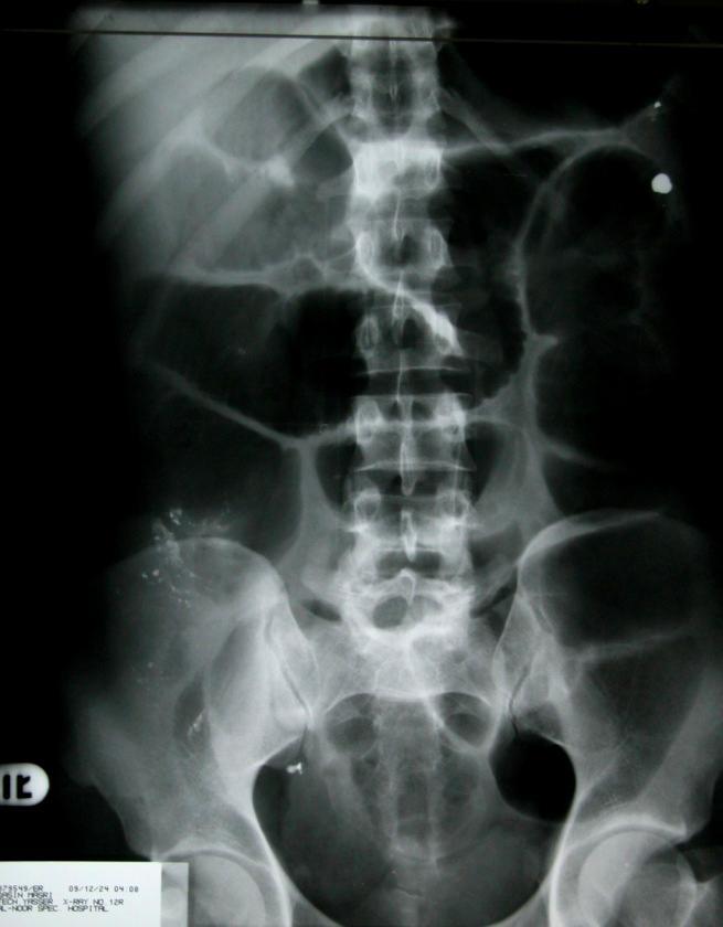 max) Presence of haustration Small Bowel Central (