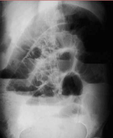 SMALL BOWEL OBSTRUCTION Note