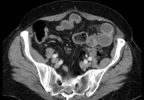 CT- SMALL BOWEL OBSTRUCTION DISTAL NORMAL BOWEL PROXIMAL DILATED BOWEL Proximal loops are dilated and distil loops are