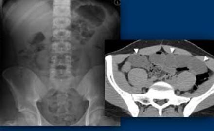 LEFT: Plain abdominal film in a patient with an acute abdomen, showing no abnormalities.
