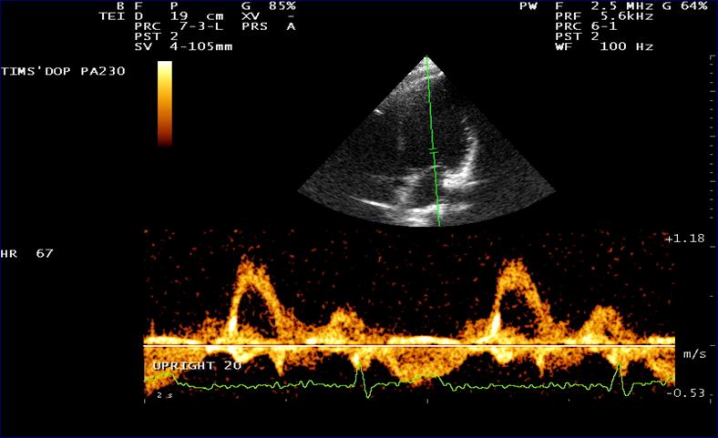 Typical Ultrasound of flow across