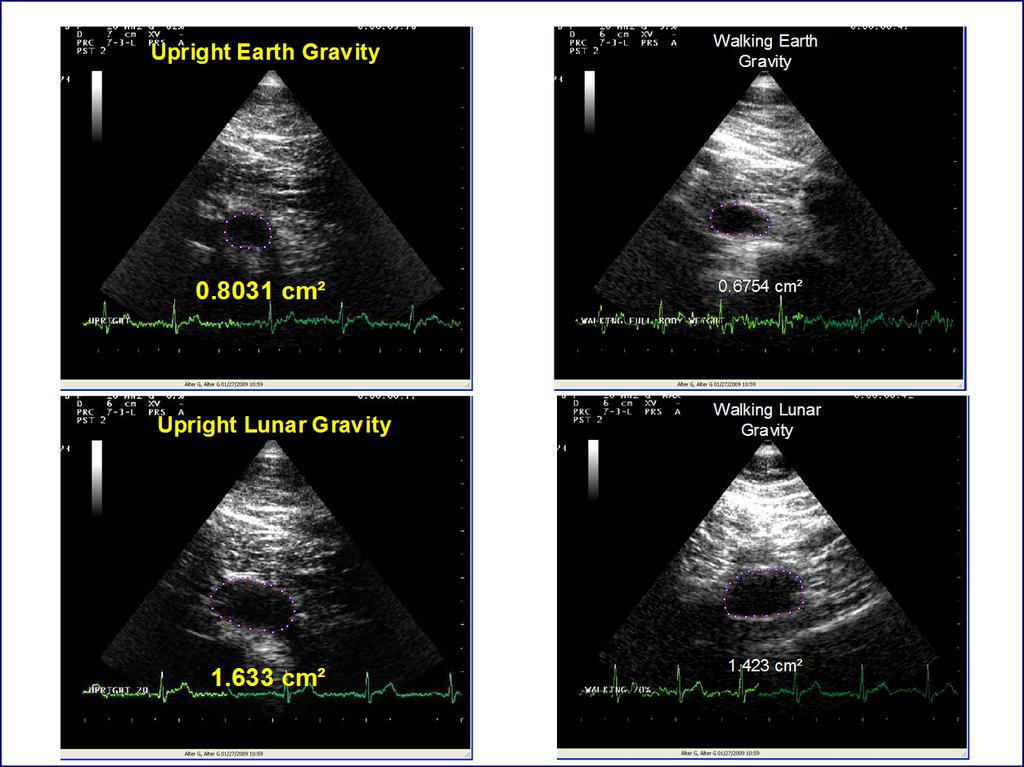 Ultrasound Results Ultrasound images of the right subclavian vein during passive standing in earth gravity (top left and simulated lunar gravity (lower left).