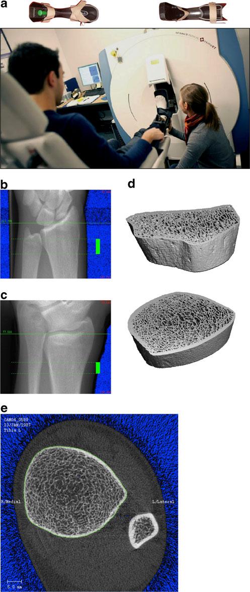 Curr Osteoporos Rep (2013) 11:136 146 139 (r 2 =0.73) [24] and cortical porosity (r 2 =0.80) [28] correlate highly with μct [28].
