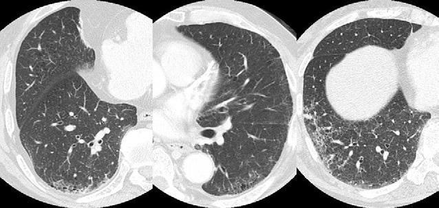Ann Thorac Surg ITO ET AL 2011;91:874 9 SUBPLEURAL HONEYCOMBING IS A RISK FACTOR 875 Abbreviations and Acronyms ALI acute lung injury ARDS acute respiratory distress syndrome CT computed tomography