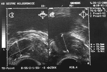 Slika 5. Karcinom unutar prostate Ultrazvuk pokazuje hipoehogeni karcinom unutar desnog lobusa prostate 1.3.