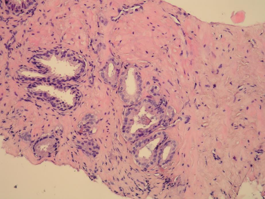 2.2. Atipična proliferacija malih acinusa (ASAP) ASAP pokazuje neka obilježja koja upućuju na karcinom prostate, ali ipak nedostatno da bi se proglasio karcinomom.