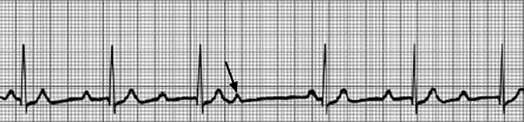 β-blockers for Cardiac CT Fig. 1 ECG lead strips. (Reprinted with permission from CLS Provider Manual, 2001, 2002 merican Heart ssociation [19]), Second-degree heart block, type I.