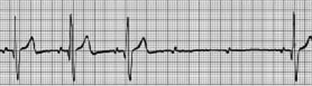 Regular PR QRS intervals occur until there are two dropped beats. C, Third-degree atrioventricular block. There is no relationship between P waves and QRS complex.