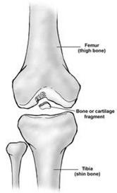 Anatomy: Loose Body Loose floating fragment of cartilage or bone Pain is felt deep in the knee Pain usually when the knee is straight 61 Anatomy: Loose Body