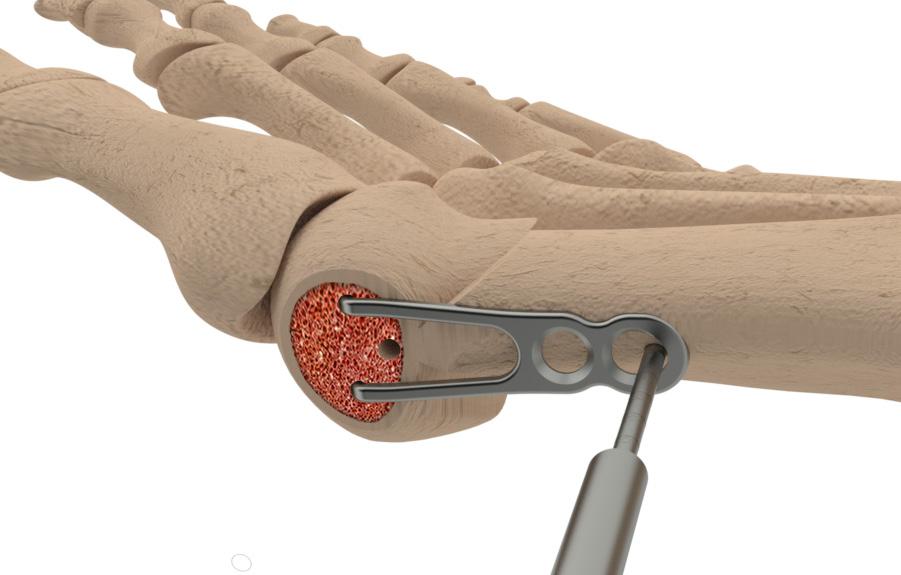 While ensuring full reduction of the metatarsal head, maintain compression of the head at the osteotomy site on the metatarsal shaft.