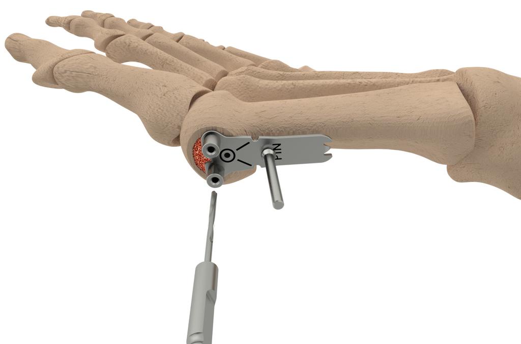 Alternative Surgical Technique - Other Osteotomies With planning, the Re+Line Bunion Correction Plate can be used with other osteotomies, including Long Arm Chevrons, Reverdin Laird, Large Correction