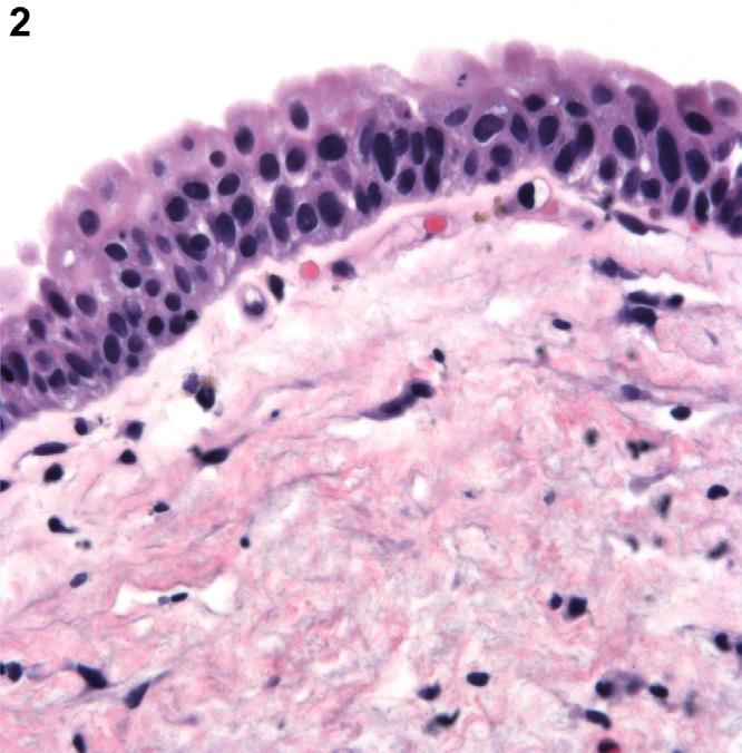 encouraged (GR: C). 3.1.2.2. Microinvasive urothelial carcinoma. Currently, there are no prospective studies or universally accepted guidelines for utilization of this terminology (LE: 4).