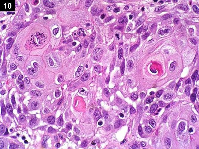 Urothelial carcinoma with divergent differentiation Urothelial carcinoma has a propensity for divergent differentiation, with the most common squamous differentiation followed by glandular