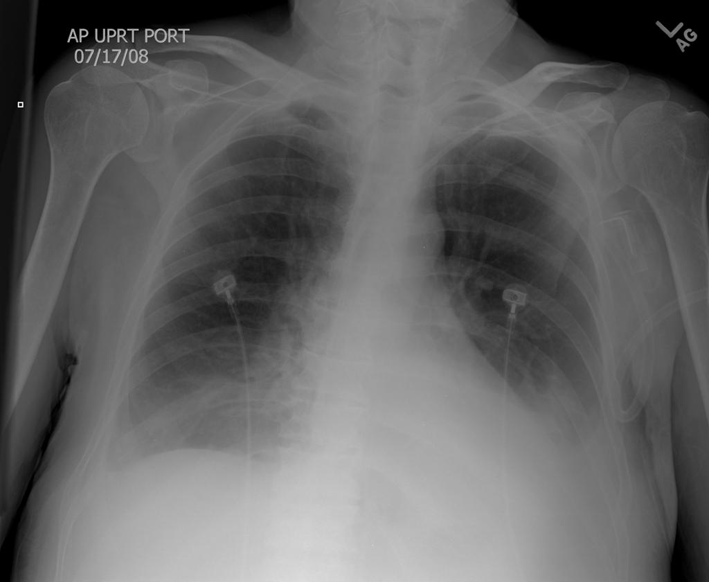 Bilateral pulmonary