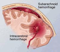 Cerebral salt wasting Inappropriate urinary salt loss + reduced effective arterial blood volume in Neurologic Patient Volume restriction exacerbates cerebral