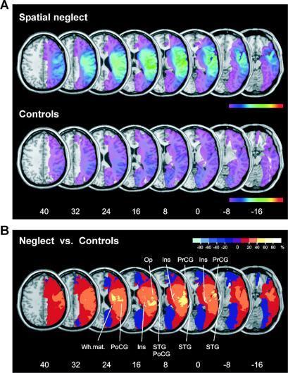 lesion subtraction Patients with similar brain damage but without the deficit are critical to identify