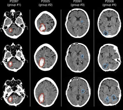Automated lesion delineation CT scans: Gillebert, C.R., Humphreys, G.W., & Mantini, D. (2014). Automated delineation of stroke lesions using brain CT images. Neuroimage: Clinical, 4:540-548.