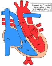 L TGA Congenitally-corrected Long-term sequelae Systemic RV dysfunction Tricuspid regurgitation Heart block L TGA and pregnancy Systemic RV has an impaired ability to tolerate workload and increased