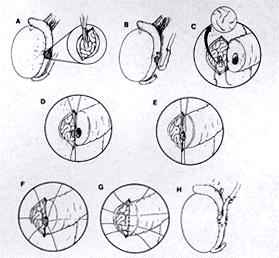 It is easier to leave the last two or three sutures unties until they are all placed. FIGURE 8. The outer layer is completed with 8-0 sutures. FIGURE 9.