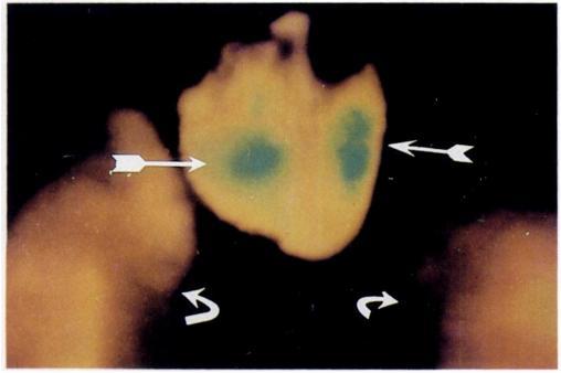 quent selective spermatic venography demonstrated reflux into the testicular pampiniform plexus in 1 6 cases.
