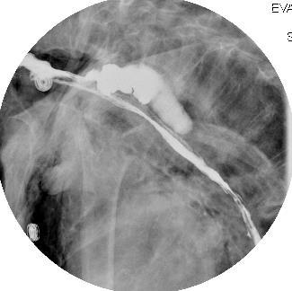 Esophageal Injury Esophagram in same patient 5-10 mm perforation at the